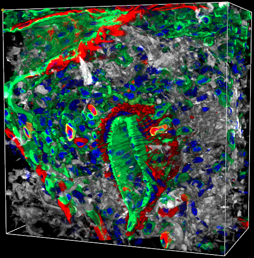 Fibrotic Arteriole Merged