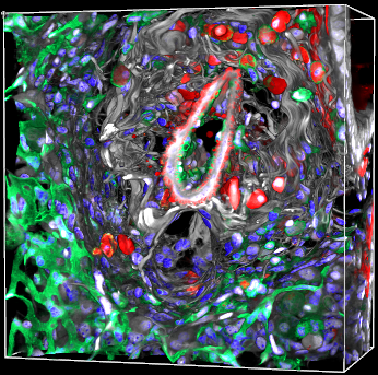 Fibrotic Arteriole