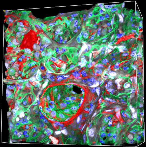 Fibrotic Venule